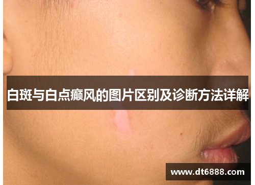 白斑与白点癫风的图片区别及诊断方法详解